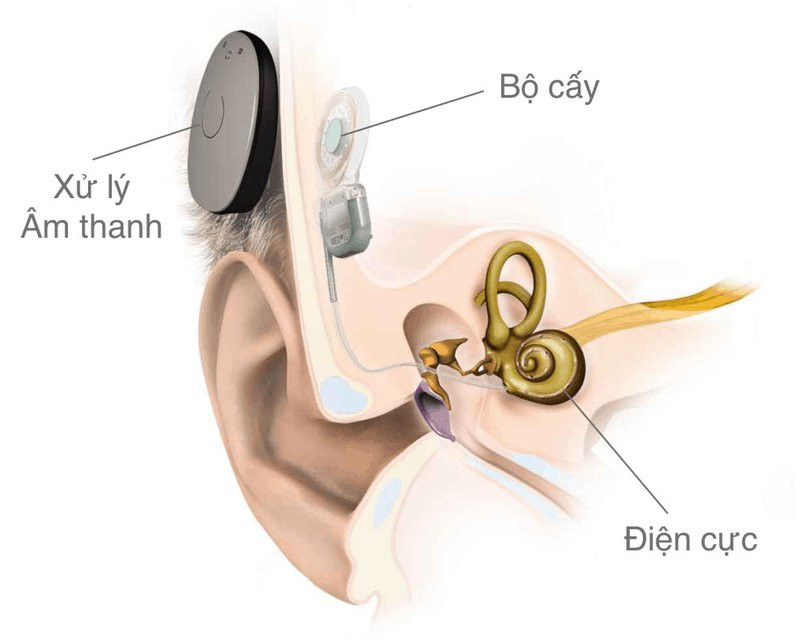 Cấy ốc tai điện tử