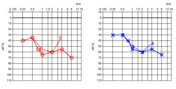 Thính lực đồ của nghe kém tiếp nhận