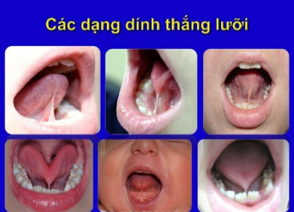 Dính phanh lưỡi (dính thắng lưỡi) ở trẻ em